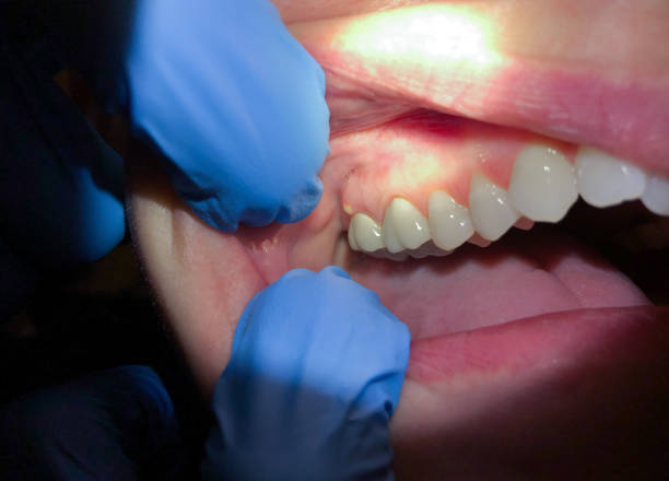 Tooth Infection Emergency Dentist in IL