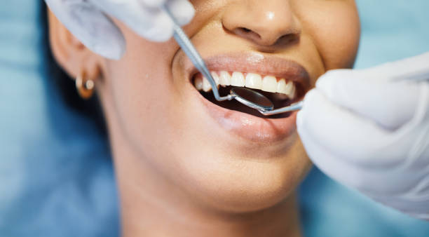 Teeth Whitening in IL